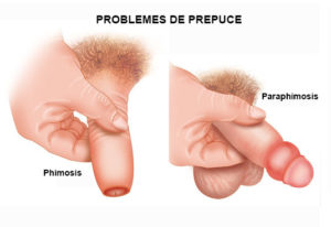 Groupe Urologie Saint-Augustin : Posthectomie totale